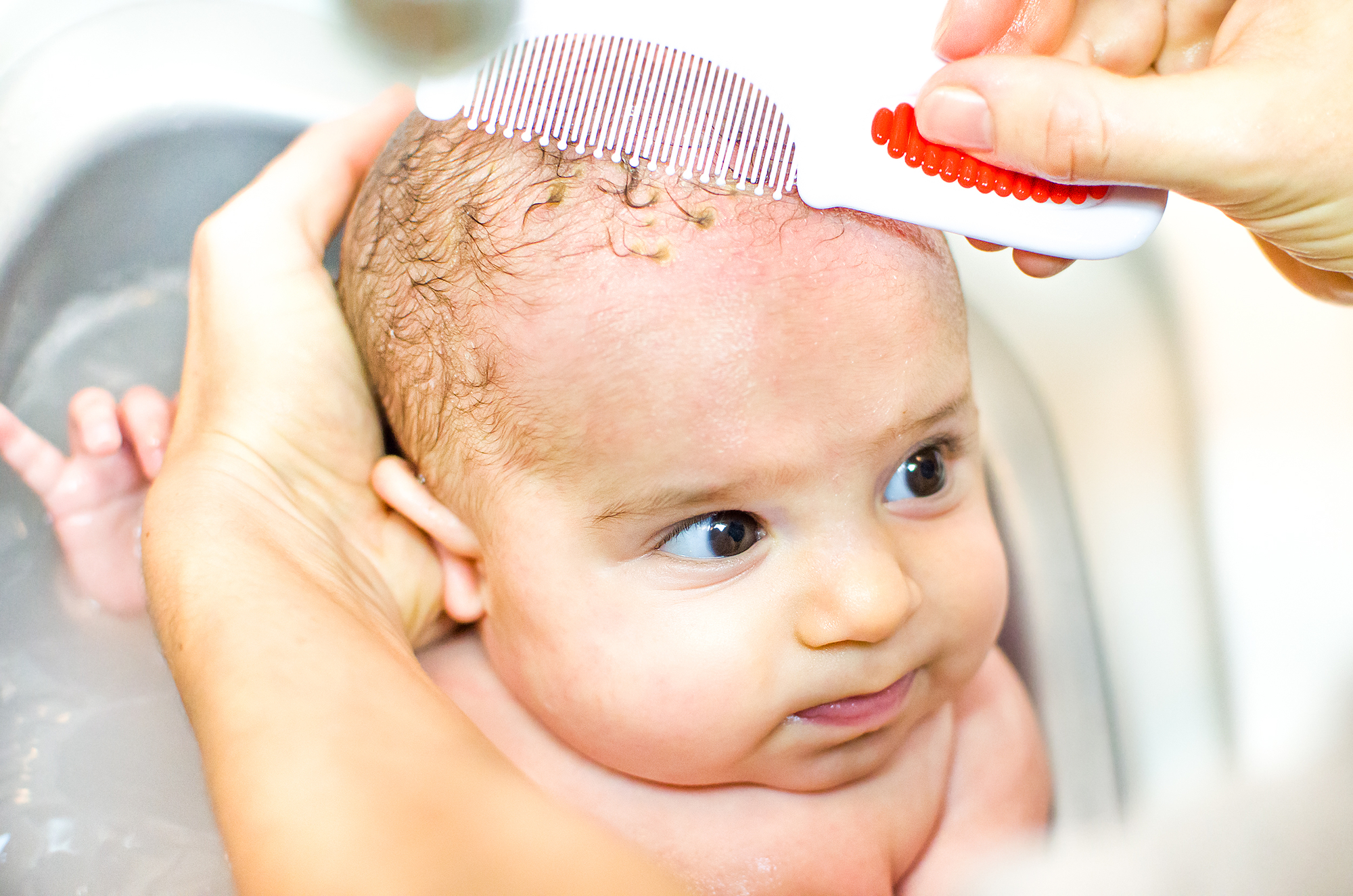 Cradle Cap Epidemic Answers