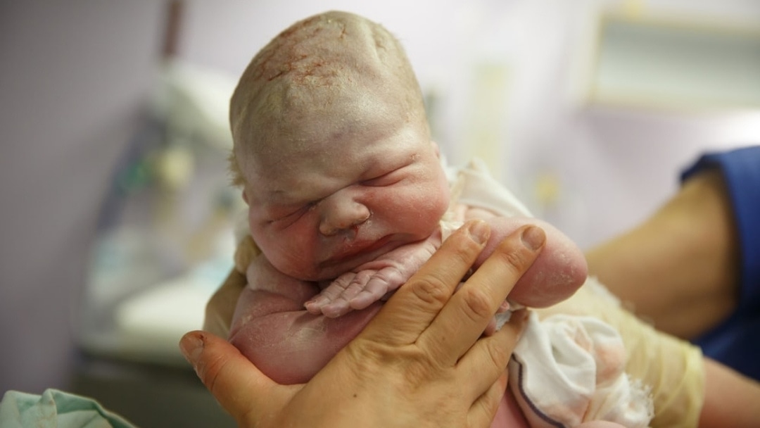Birth Trauma: A Common Cause of Developmental Delays