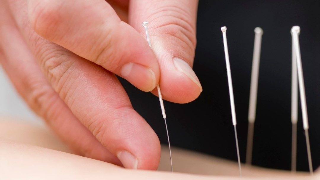 Acupuncture for Kids